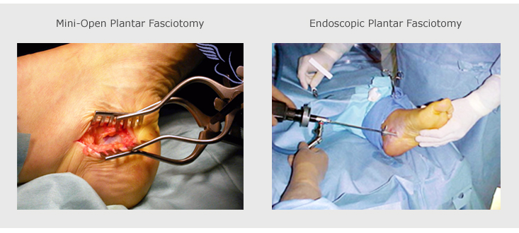 Open & Endoscopic Plantar Fasciotomy Surgeries