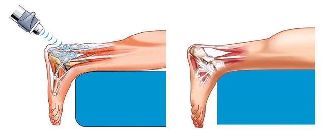 Extracorporeal shockwave therapy