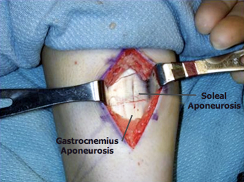 Gastrocnemius Recession Surgery