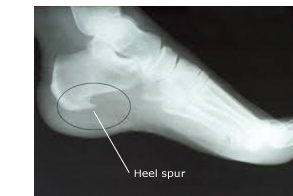 Posterior Calcaneal Spur