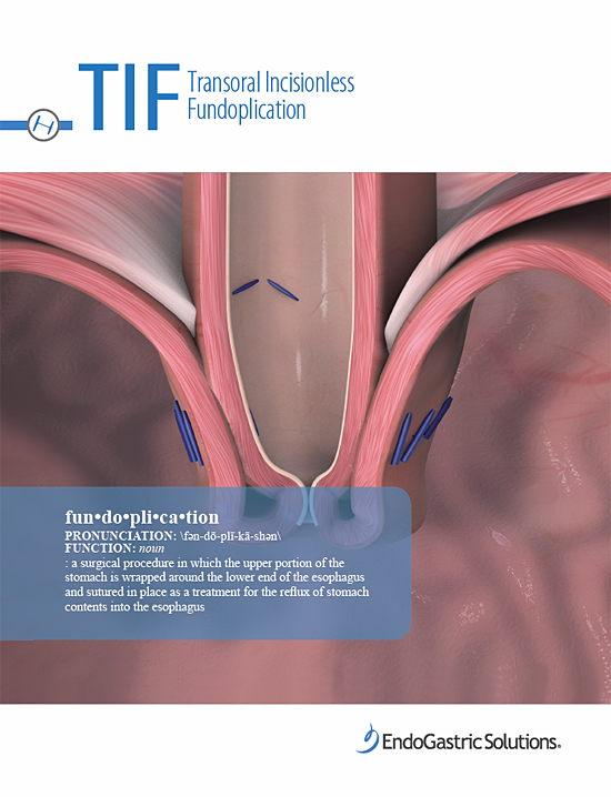 TIF Fundoplication brochure